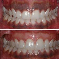 Gum Depigmentation 4 Gum Depigmentation in Dubai & Abu Dhabi