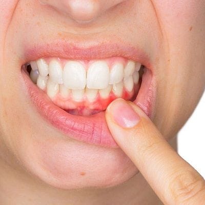 Gum Recession Treatment in Dubai