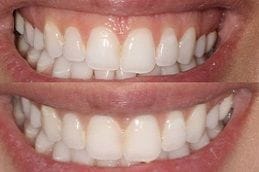 Gummy Smile Treatment 1 Gummy Smile Treatment in Abu Dhabi