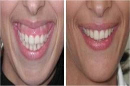 Gummy Smile Treatment 2 Gummy Smile Treatment in Dubai and Abu Dhabi