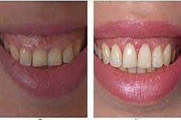 Gummy Smile Treatment 3 Gummy Smile Treatment in Dubai