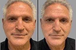 HIFU Treatment Before After