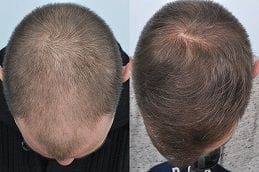 Hair Loss Treatment 5 Hair Loss Treatment Before & After