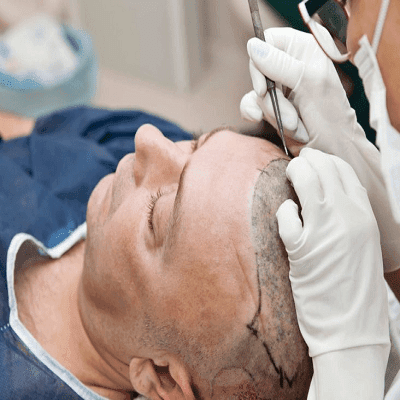 Hair Restoration With DHI Technique in 2023