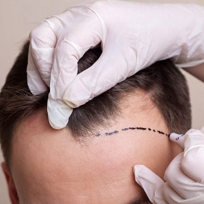 Hair Transplant Silicon Oasis