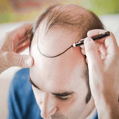 Hair Transplant in Fujairah