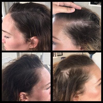 Hairline Microblading Dubai 1 Hairline Microblading Dubai & Abu Dhabi