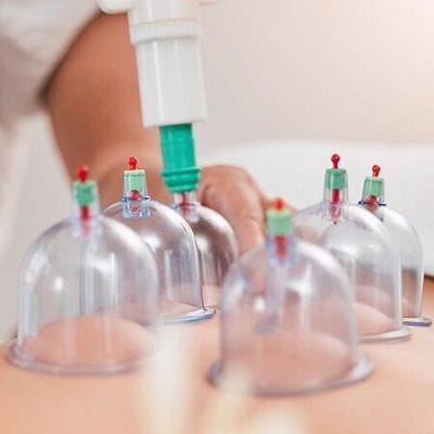 Hijama For Weight Loss In Dubai 5 Ways How It Works