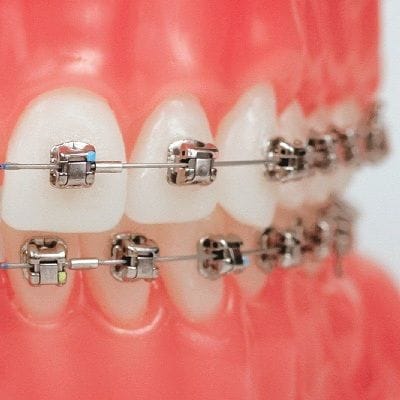 How Does Damon Braces Work in Dubai