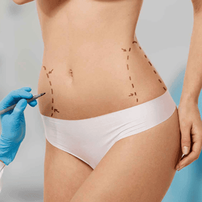 How Long Do Tummy Tuck Results Last? 1 How Long Do Tummy Tuck Results Last?