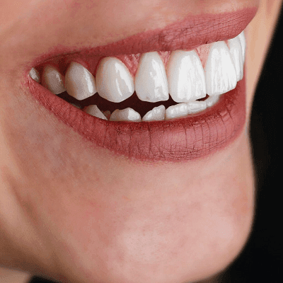 How Long Does A Bonding Appointment Take In Dubai?