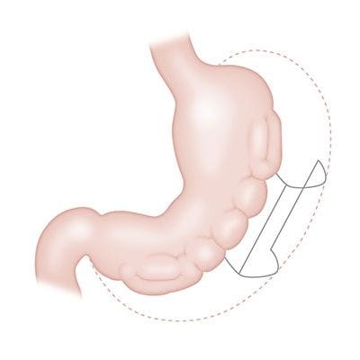 How Long Does Gastric Plication Last? 1 How Long Does Gastric Plication in Dubai Last?