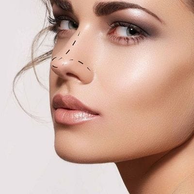 How Long Does Non Surgical Rhinoplasty Last