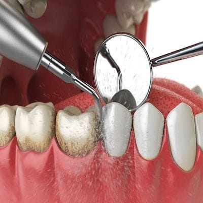 How Long Does Teeth Cleaning Take