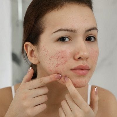How Long Does it Take Acne Scars to Heal 1 How Long Does it Take Acne Scars to Heal