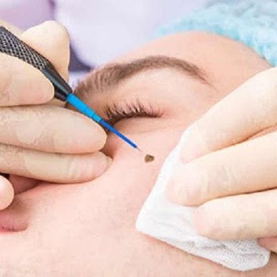 How Long Does it Take to Recover From a Wart Removal