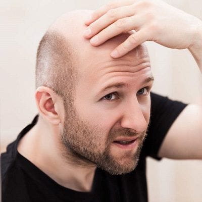 How Many Grafts are Needed for a Full Head? 1 How Many Grafts are Needed for a Full Head