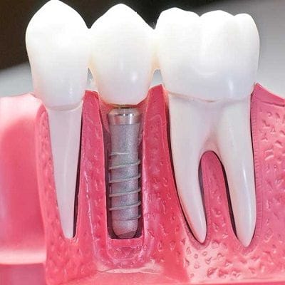 How Much Does It Cost To Fix A Loose Dental Implant Loose Dental Implant
