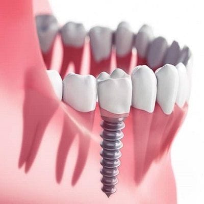 How Much Does it Cost to Replace all Teeth with Dental Implants?
