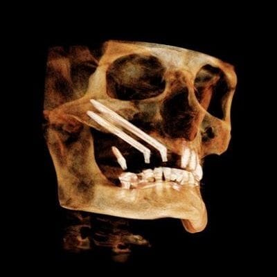 How Painful are Zygomatic Implants ?