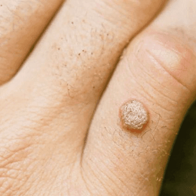 How Salicylic Acid Help in Wart Removal