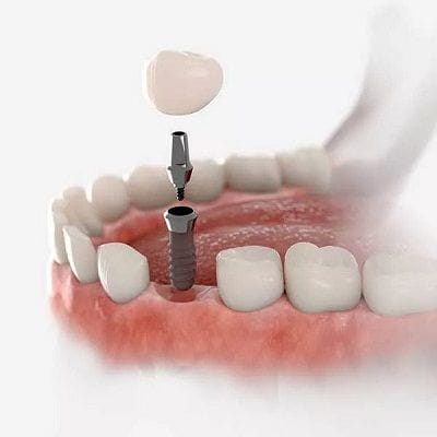 How Titanium Implant is Revolutionizing Dentistry?