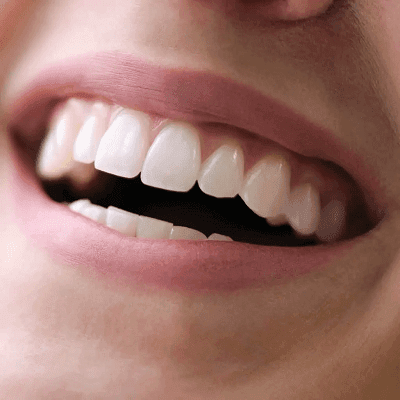 How To Keep Your Veneers Looking New