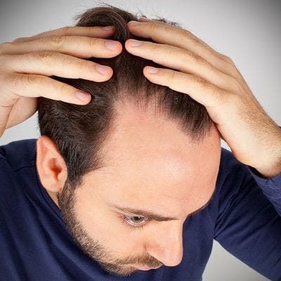 How To Reverse Male Pattern Baldness? 1 How To Reverse Male Pattern Baldness?