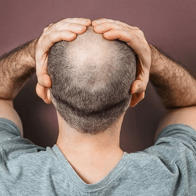 How To Treat Temple Hair Loss In Dubai