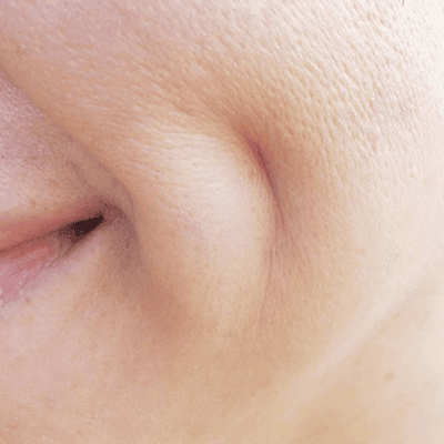 How Can I Get Dimples Permanently? 1 How can I get dimples permanently?