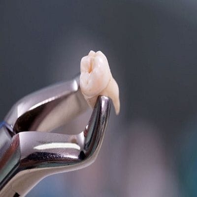 How Long Does it Take to Recover from Wisdom Tooth Removal in Dubai 1 How long does it take to recover from wisdom tooth removal in Dubai