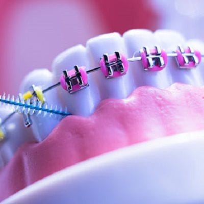 How Long Does Metal Braces Take to Straighten Teeth