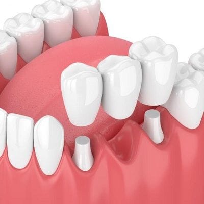 How long does tooth sensitivity last after crown in Dubai