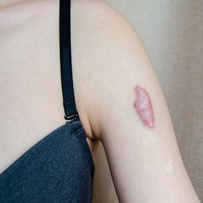 How to Choose the Right Keloid Treatment Center?