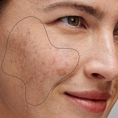How to Maximize the Benefits of Pigmentation Treatment? 1 How to Maximize the Benefits of Pigmentation Treatment