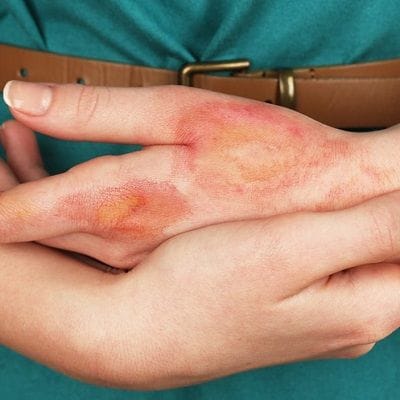 How to Minimize Scarring from a Second-Degree Burn?
