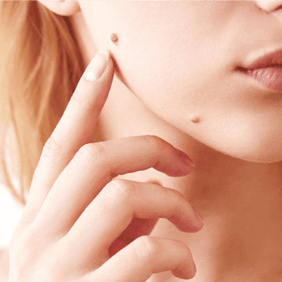 How to Permanently Get Rid of Warts? 1 How to Permanently Get Rid of Warts?