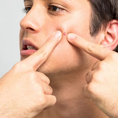 How to Remove Pimples Overnight
