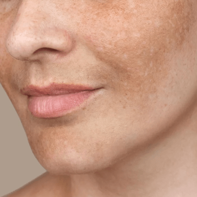 How to Quickly Fade Hyperpigmentation? 1 How to quickly fade hyperpigmentation?
