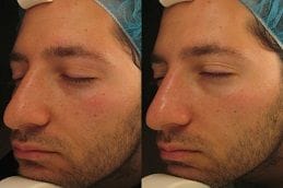 Hydrafacial men before and after in Dubai, Abu Dhabi