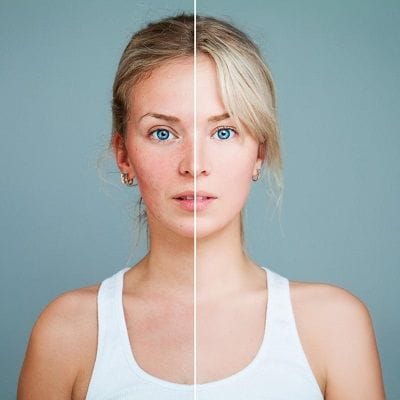IPL Treatment for Rosacea