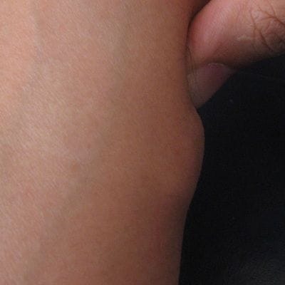 Important Facts About Lipoma Treatment 1 Important Facts About Lipoma Treatment in Dubai Dynamic Clinic