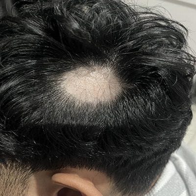 Improve Hair Density with Alopecia Areata Treatment 1 Improve Hair Density with Alopecia Areata Treatment