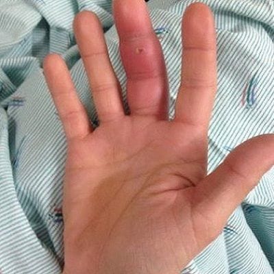 Incision and Drainage of Abscesses Dubai