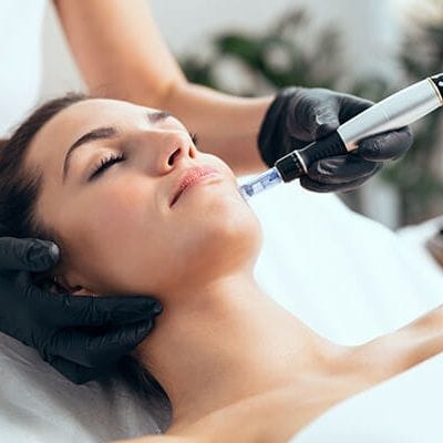 Intracel Microneedling and Radiofrequency - Treatments 1 Intracel Microneedling and Radiofrequency Treatments