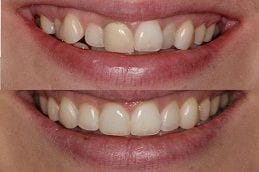 Invisalign Braces 4 Before & After Invisalign Braces in Dubai