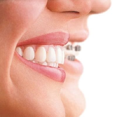 Invisalign vs Braces: A Complete Guide