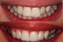 Lingual Braces 4 Invisible Lingual Braces Dubai & Abu Dhabi