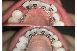 Lingual Braces 5 Invisible Lingual Braces in Dubai & Abu Dhabi