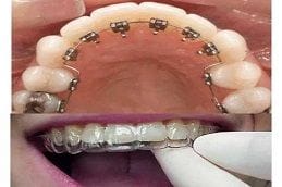 Lingual Braces 6 Invisible Lingual Braces in Dubai